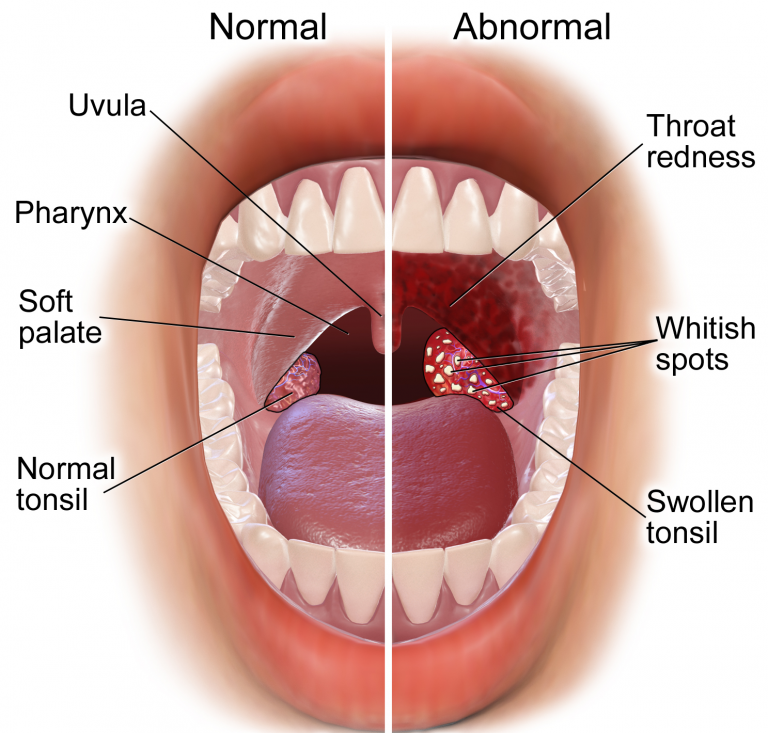 throat-infection-dr-dugad